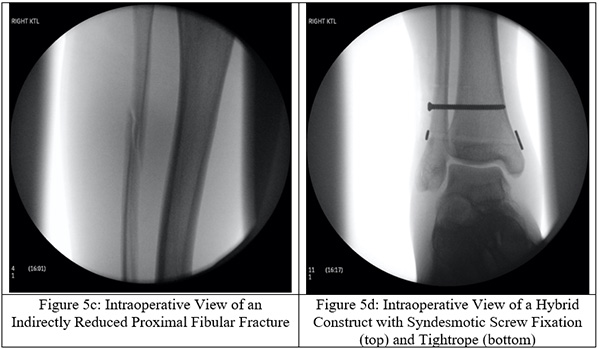 Distal fibula2