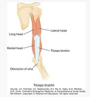 Distal Triceps Tendon Rupture img2