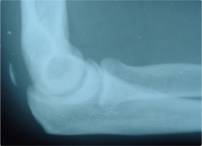 Distal Triceps Tendon Rupture