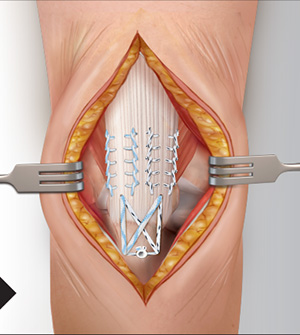 Distal Triceps Tendon Rupture Img3