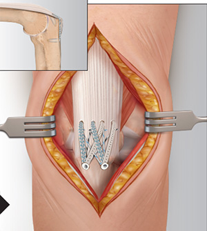 Distal Triceps Tendon Rupture Img4