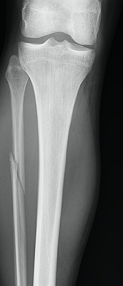 Fibular fractures