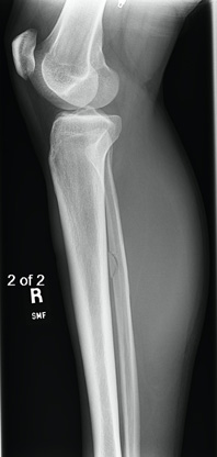 Fibular fractures Img2