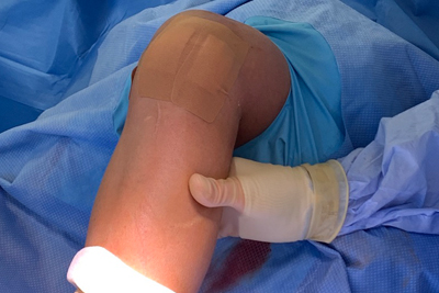 Nanoscopic Surgery at Mammoth Orthopedic Institute Img5