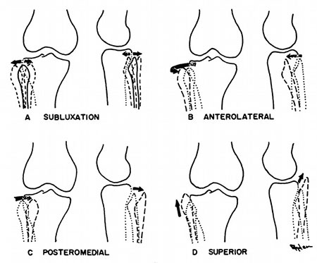 Proximal Tibiofibular Ligament Instability Img1