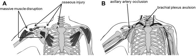 Scapulothoracic Dissociation Image2