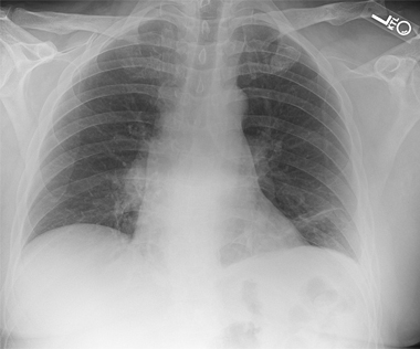Scapulothoracic Dissociation Image3