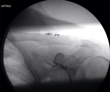 Scapulothoracic Dissociation Image4