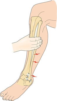 Maisonneuve fractures img3