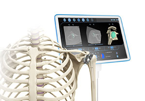 3D Planning for Shoulder Replacement
