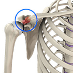 Acromioclavicular (AC) Joint Osteoarthritis