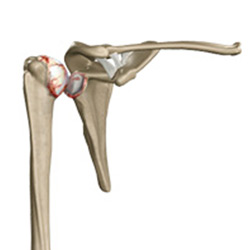 arthritis of the shoulder