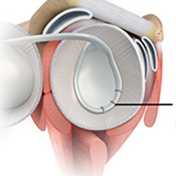 arthroscopic bankart repair