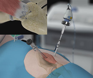 Arthroscopic Gluteus Medius Tendon Repair