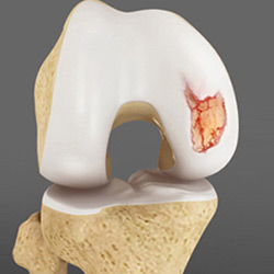 Articular Cartilage Injury