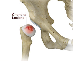 Chondral Lesion or Injury