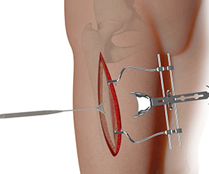 Complex Hip Reconstruction Surgery