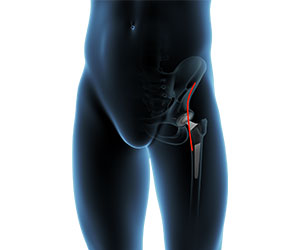 Picture of Direct Anterior Minimally Invasive Hip Replacement