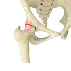 Femoroacetabular Impingement