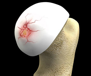 Hip Cartilage Repair