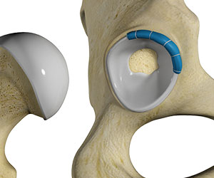 Hip Labral Reconstruction