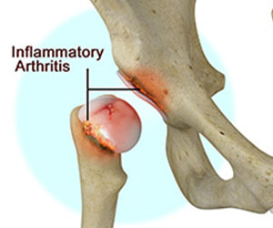 Inflammatory Arthritis of the Hip