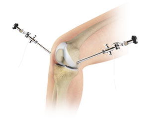 Knee Arthroscopy