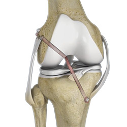 Knee Cartilage Restoration