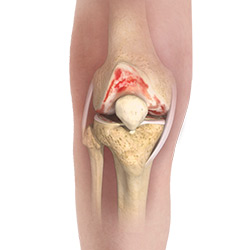 Knee Osteoarthritis Treatment