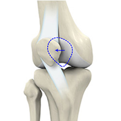 Lateral Patellar Instability