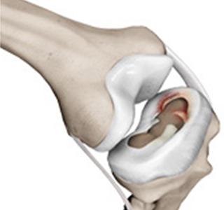 Meniscal Injuries