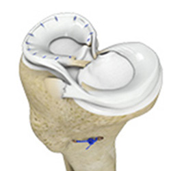 Meniscal Repair Surgery