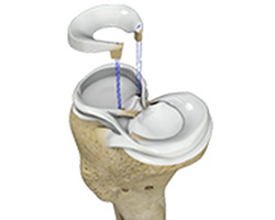 Meniscal Transplantation