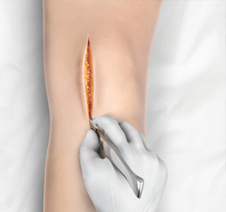 Minimally Invasive Knee Joint Replacement