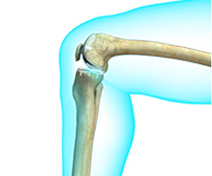 Picture of Partial Knee Replacement