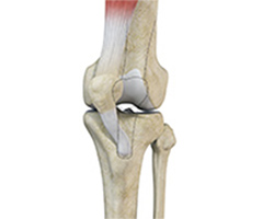 Patellar Instability