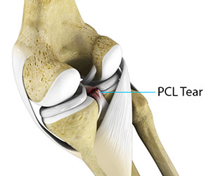 Posterior Cruciate Ligament Injuries