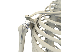 reverse shoulder replacement