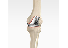 Revision Knee Replacement