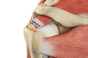Revision Rotator Cuff Surgery