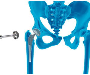 Robotic Assisted Hip Replacement