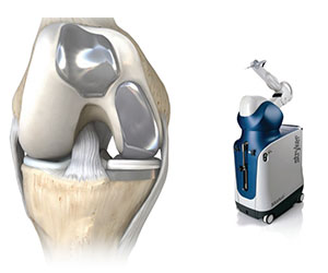 Robotic Assisted Partial Knee Surgery