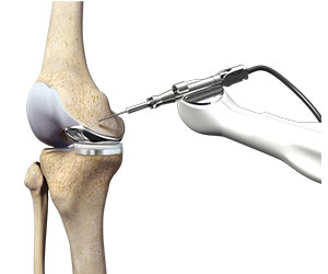 Robotic Unicondylar Knee Replacement