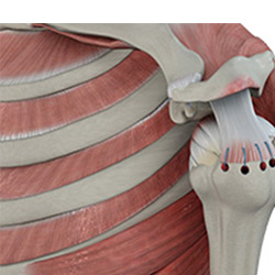 rotator cuff repair