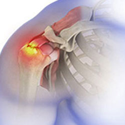 rotator cuff tear