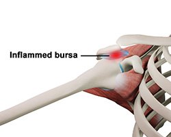 shoulder bursitis