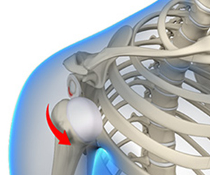 shoulder instability