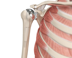shoulder joint replacement