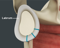 shoulder labrum reconstruction