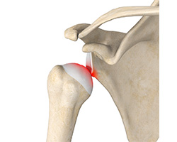 shoulder stabilization